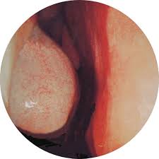 患有鼻炎吃什么药好