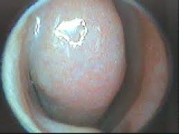 治疗鼻息肉费用要多少钱