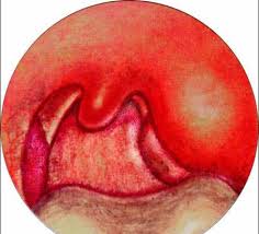 引发肥厚性鼻炎的病因