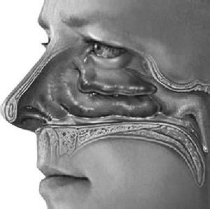 鼻甲肥大的危害