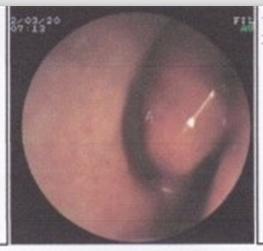 鼻息肉术后护理注意事项