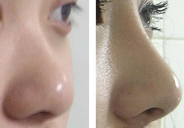 鼻甲肥大有何危害