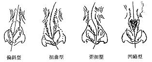 鼻中隔偏曲术后护理很重要
