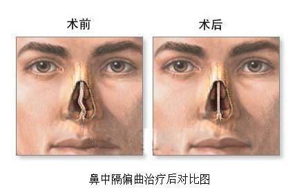 鼻中隔偏曲的病因有哪些
