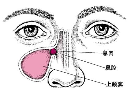 如何确诊鼻甲肥大