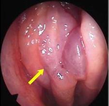 鼻息肉会出现什么症状