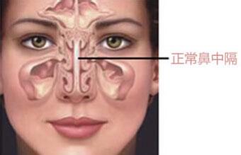 怎样识别鼻中隔偏曲